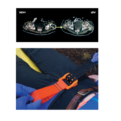 Ceinture de contention pelvienne SAM SLING